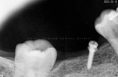 돌출입 및 신경치료와 임플란트 식립 동시 진행 증례 관련 이미지 14