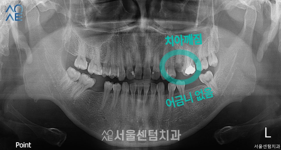 상악동수술 동반한 임플란트 진행한 이야기 관련 이미지 1