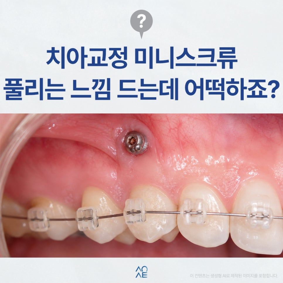 교정 미니스크류 풀리는 것 같은데 그대로 내버려둬도 되나요? 관련 이미지 1