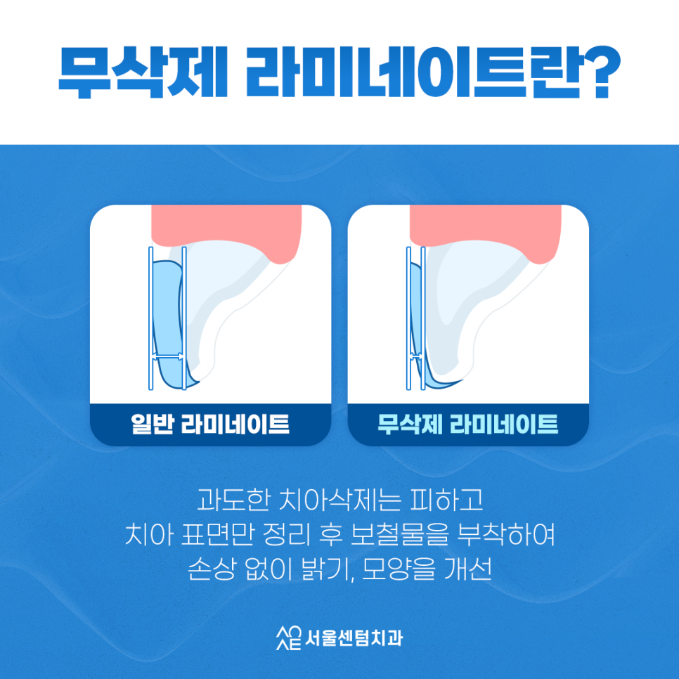 무삭제 라미네이트 안되는 분들도 많습니다. 관련 이미지 2