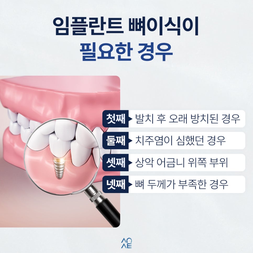 임플란트 뼈이식 꼭 해야할까요? 필요한 경우 관리 방법 정리본 관련 이미지 3