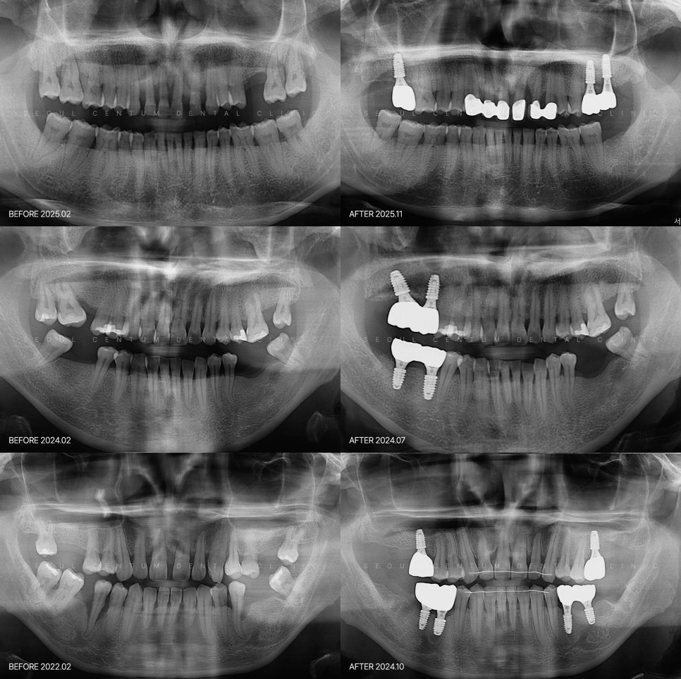 임플란트 치주염 옆자리에 권유받았다면 필요한지 판단할 것 관련 이미지 7