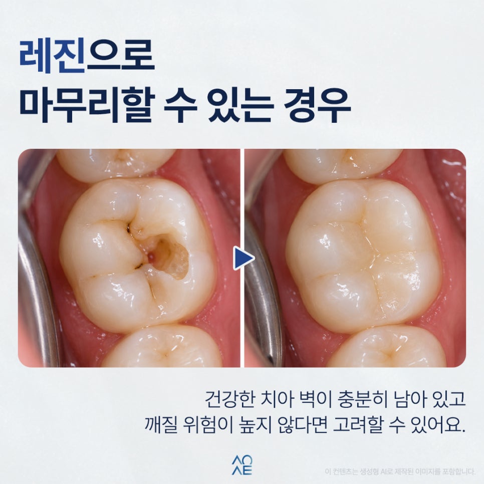 신경치료 후 크라운이랑 레진 중에 뭐가 더 낫나요? 관련 이미지 2