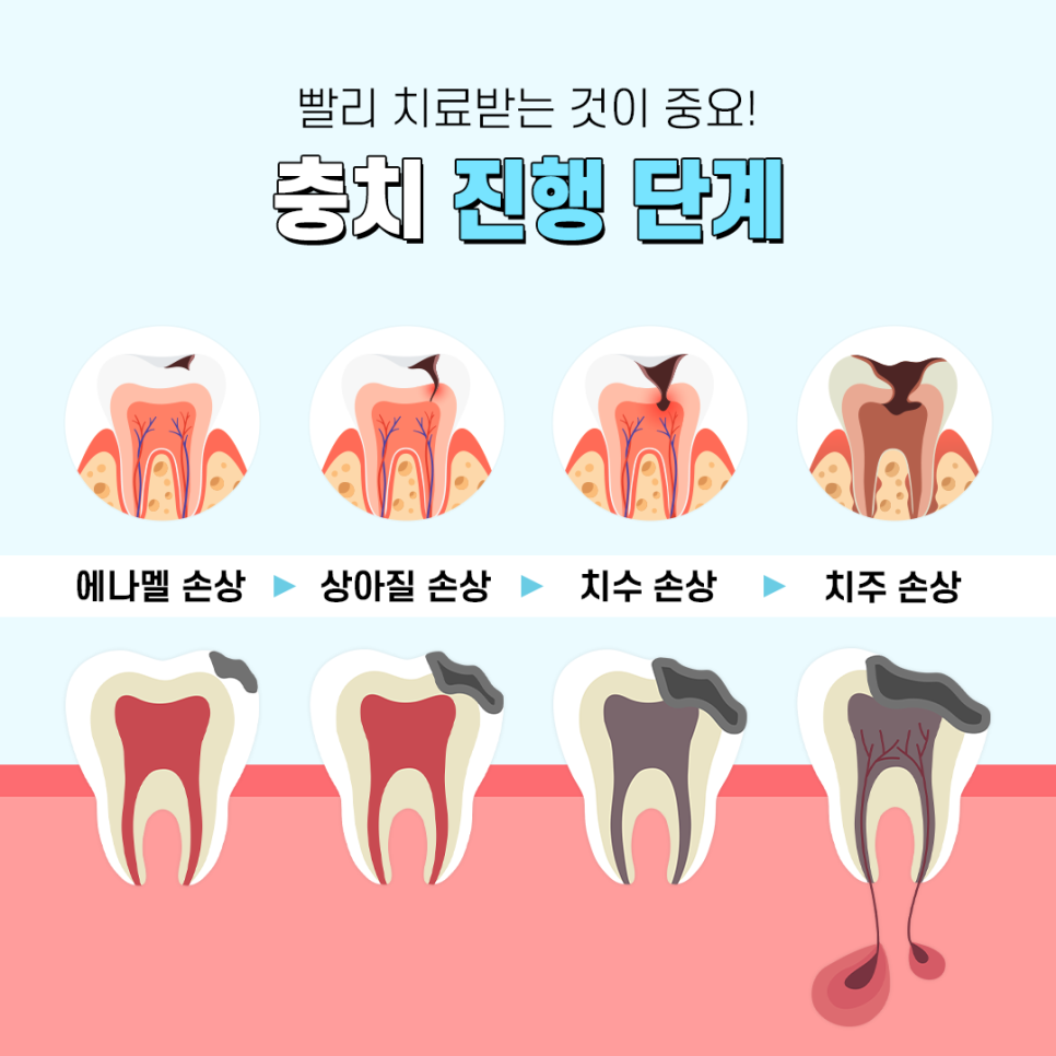 충치치료 나는 어떤 단계일까 관련 이미지 2