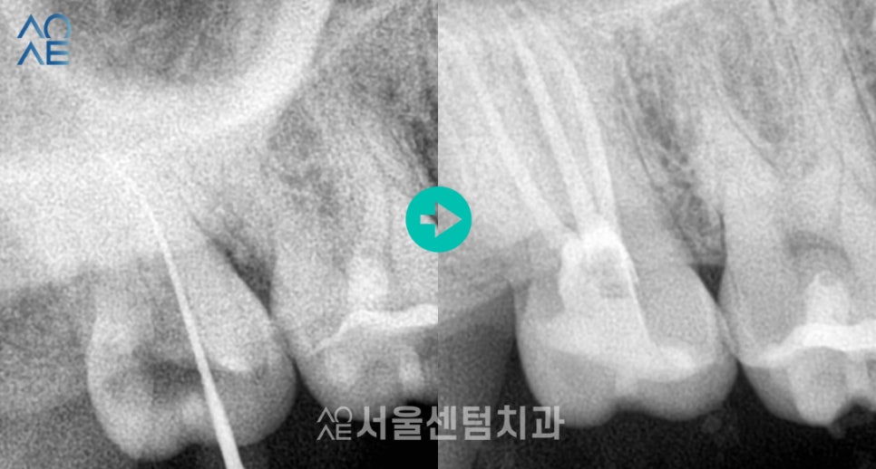 치아 신경치료 단계 임플란트까지 고려한다면 관련 이미지 2