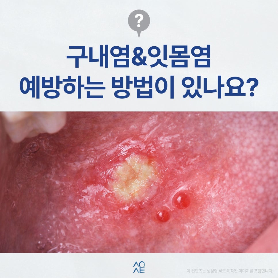 구내염 잇몸염 모두 제대로 예방하고 싶은 분들만 보세요 관련 이미지 1