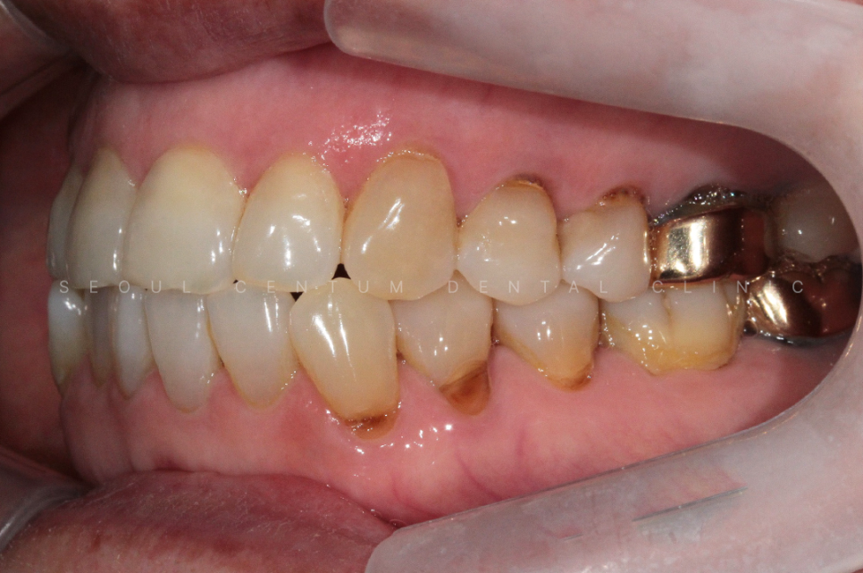 치경부마모증 가격 gi 레진 갈색치아 원인 통증 관련 이미지 13