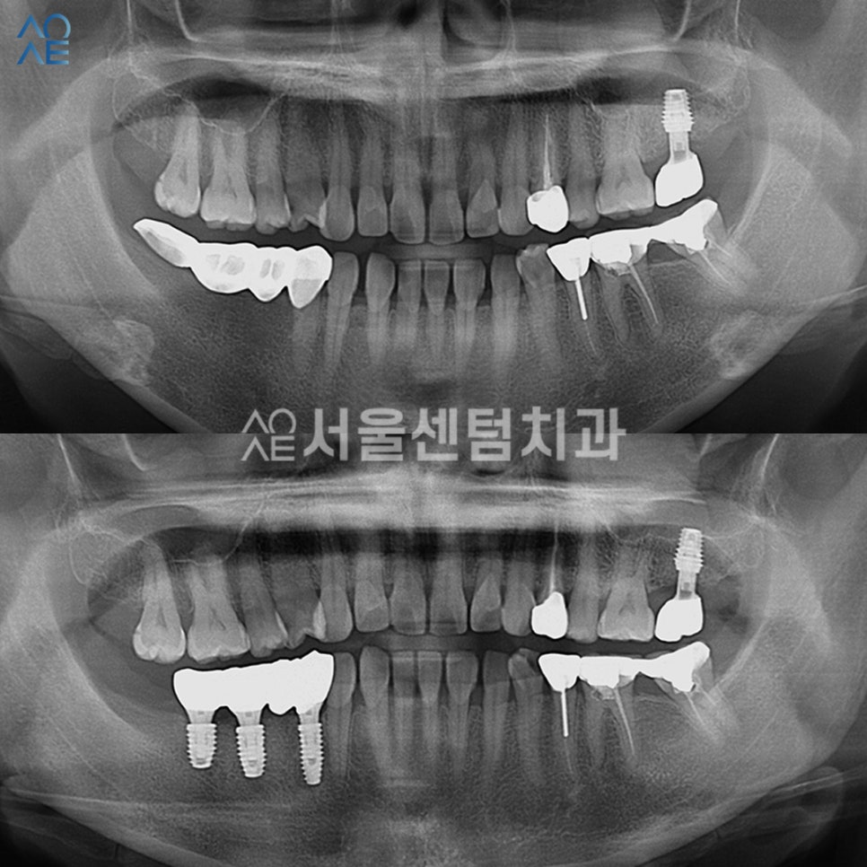 40대임플란트 수술 어떻게 하나요? 관련 이미지 5