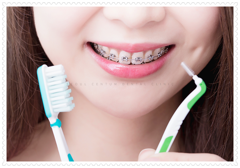 교정치료 중 주의사항 기억해두고 실천하면 좋아요 관련 이미지 8