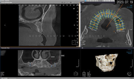 전체임플란트 기간 예상보다 줄어들 수 있는 방법과 증례 공개 관련 이미지 6