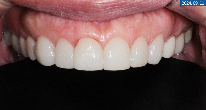 라미네이트전후 치아의 가지런한 정도와 밝기 차이 확인하기 관련 이미지 14