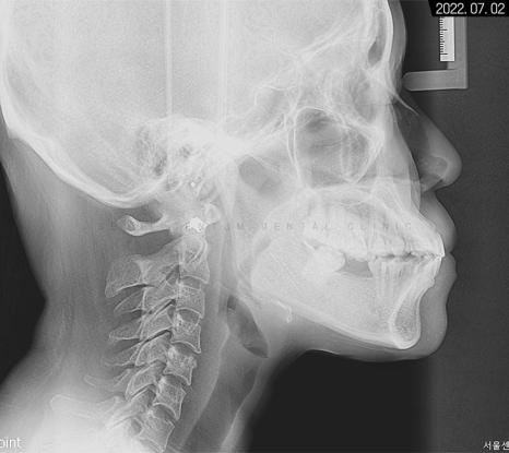 돌출입 및 신경치료와 임플란트 식립 동시 진행 증례 관련 이미지 4