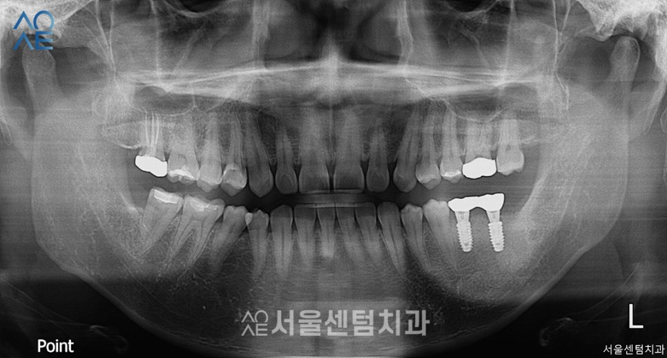 치아 신경치료 단계 임플란트까지 고려한다면 관련 이미지 5