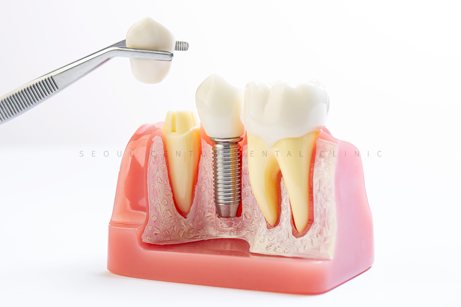 뼈이식 임플란트와 라미네이트 수복 증례 소개 관련 이미지 2