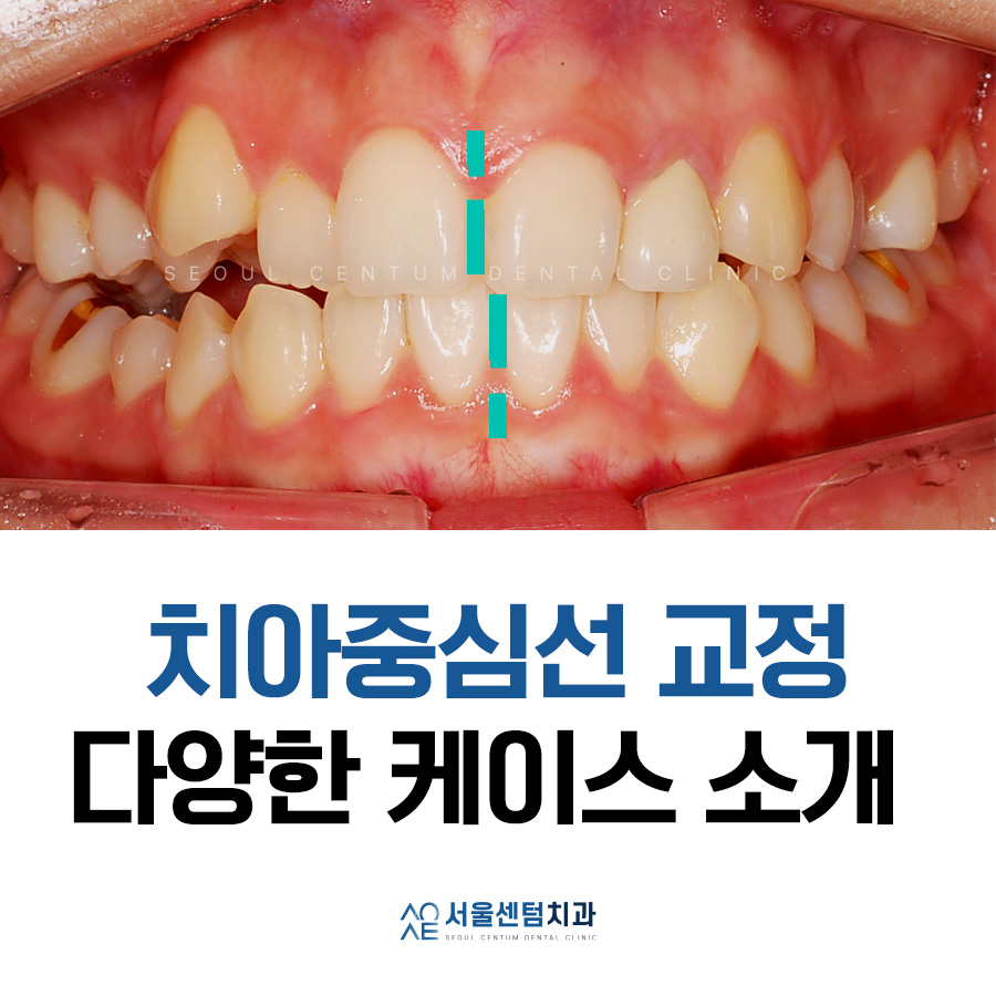 치아중심선교정 다양한 실제사례 보여드려요 관련 이미지 1