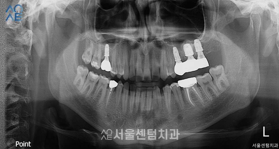 20대임플란트후기 진행과정부터 상세히 관련 이미지 5