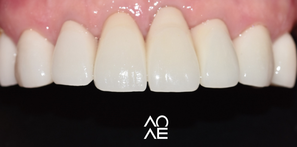 잠원동 교정 반대교합 크라운 치료도 가능합니다. 관련 이미지 6