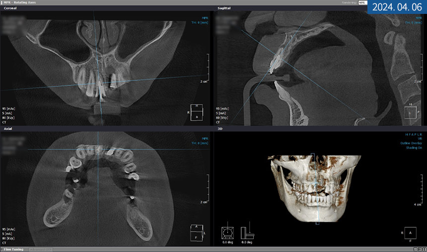 앞니 임플란트 식립으로 저작 기능을 끌어올린 증례 관련 이미지 9