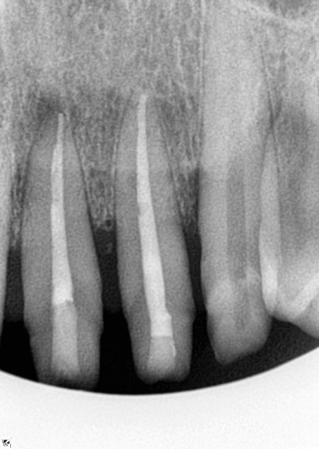 임플란트 순서 어금니부터 앞니부터 어디부터 해야할까요 관련 이미지 10