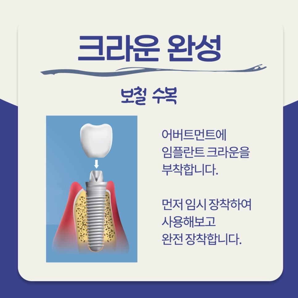 임플란트 시술과정 총 몇번 치과에 가야할까? 관련 이미지 5