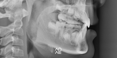 주걱턱 교정, 페이스마스크 활용 주의사항 관련 이미지 4