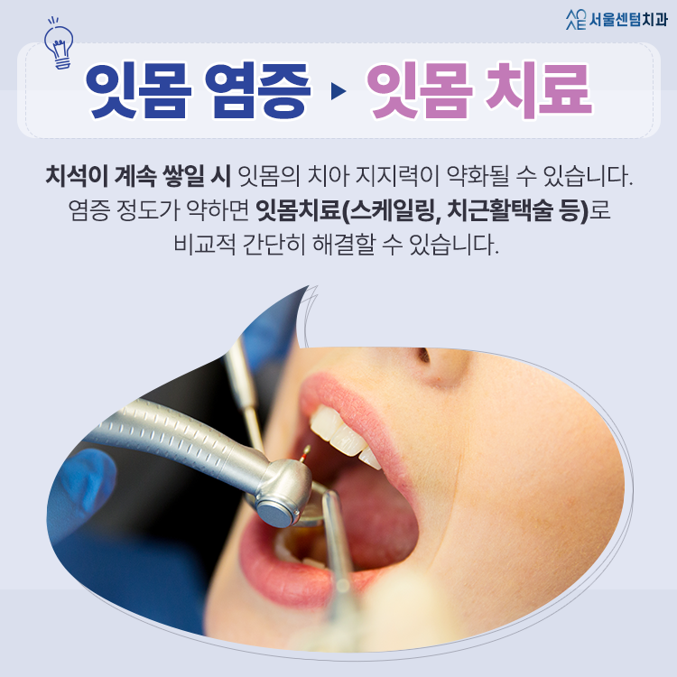 흔들리는 치아 가만히 두지 말고 즉각 치료받아야 하는 경우는? 관련 이미지 2