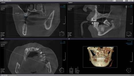 임플란트 브릿지와 크라운 수복으로 치아 기능을 회복시킨 증례 관련 이미지 13