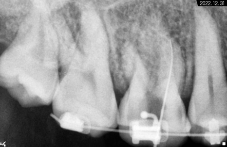 돌출입 및 신경치료와 임플란트 식립 동시 진행 증례 관련 이미지 10