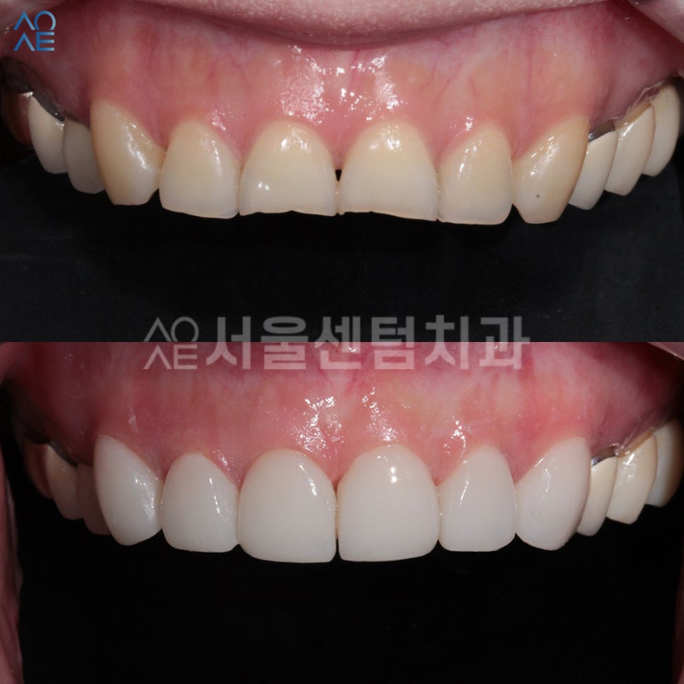 라미네이트 앞니 깨짐과 마모 해소한 증례 살펴보기 관련 이미지 5
