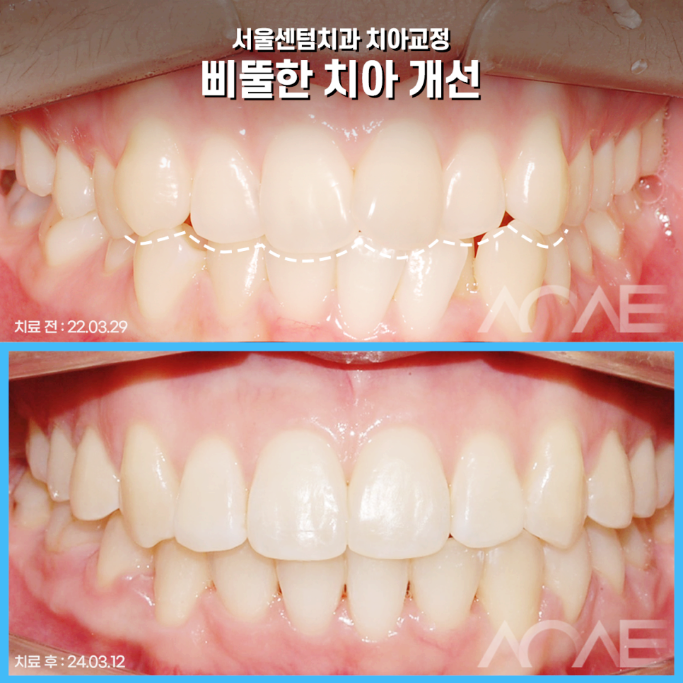 총생 앞니 덧니 발치 후 치아교정? 관련 이미지 1