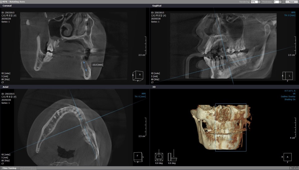 40대 임플란트 치료 케이스 상악동거상술 골이식까지 관련 이미지 5
