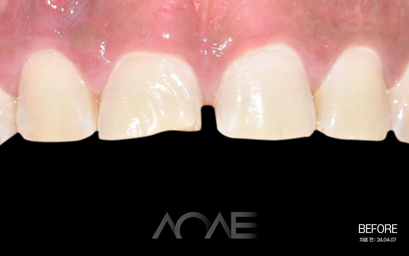 잠원동치과 무삭제 라미네이트 기간 앞니 깨짐 관련 이미지 4