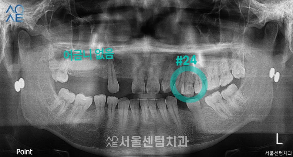 임플란트 과정 기간 실제 사례로 설명드려요 관련 이미지 1