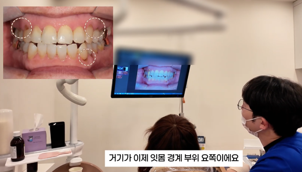 치아패임 이대로 두어도 괜찮을까요 치경부마모증 레진치료 관련 이미지 8
