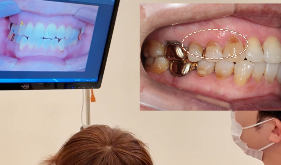 치아패임 이대로 두어도 괜찮을까요 치경부마모증 레진치료 관련 이미지 11