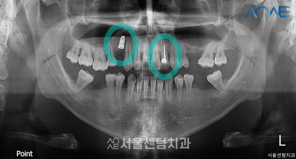Here’s How a Korean-Made Implant Is Actually Placed image 4