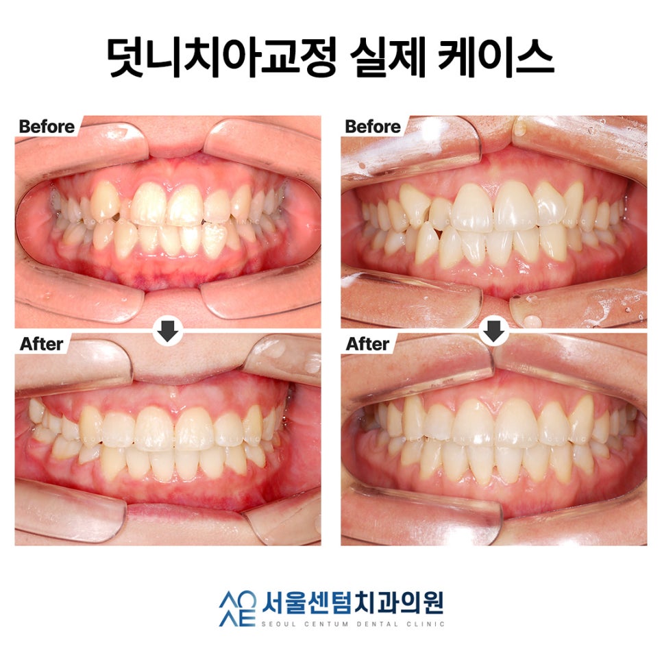 Explaining Orthodontic Treatment for Snaggletooth with Real Photos image 3
