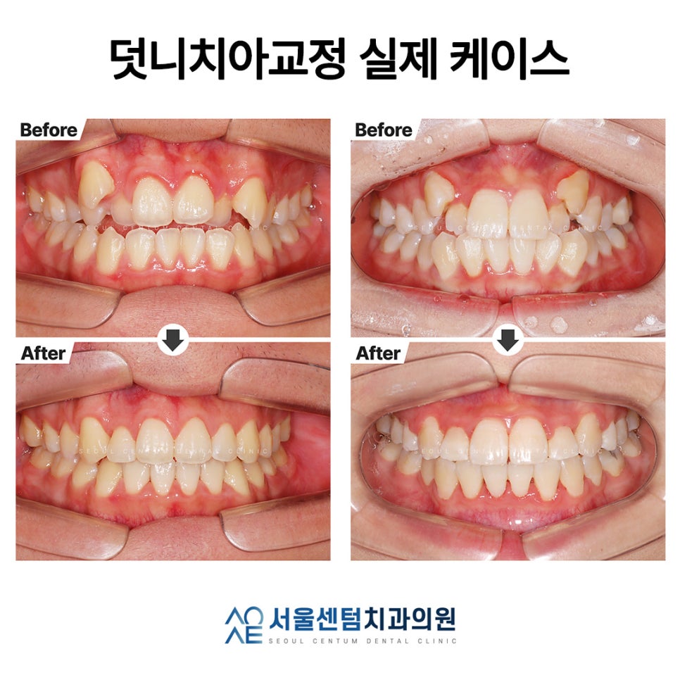 Explaining Orthodontic Treatment for Snaggletooth with Real Photos image 2
