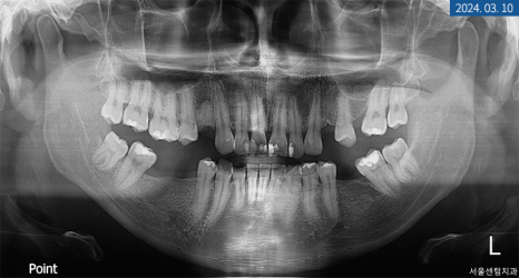 뼈이식 임플란트와 라미네이트 수복 증례 소개 관련 이미지 3