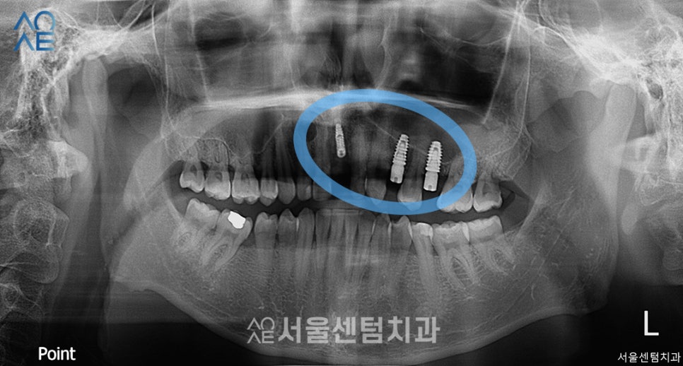 앞니 임플란트기간 실제 수술사례로 알려드려요 관련 이미지 2