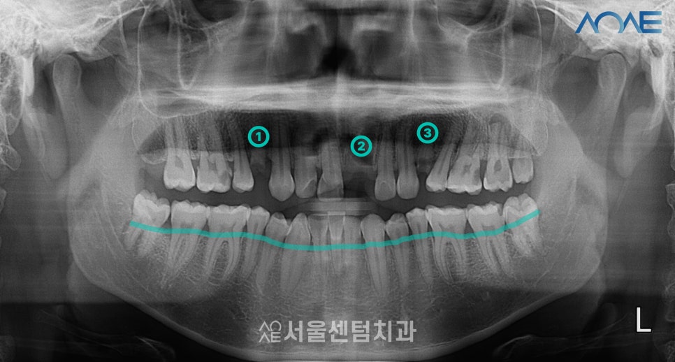 당일임플란트 상담부터 풀과정 공개 관련 이미지 2