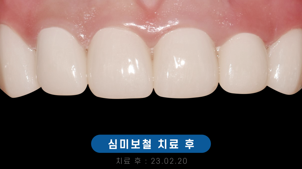 치과 앞니 사이 레진, 당일 진료 가능 관련 이미지 12