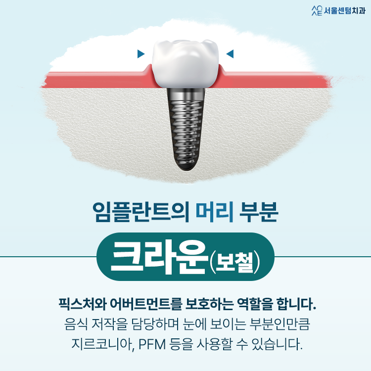 임플란트 구조 하나하나 뜯어보면 알 수 있는 원리 관련 이미지 5