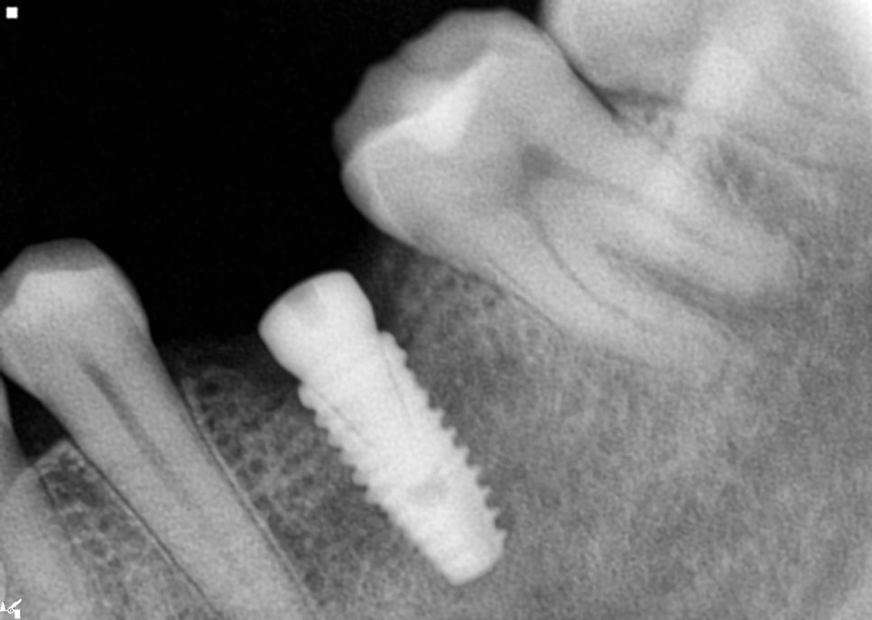 40대 임플란트 치료 케이스 상악동거상술 골이식까지 관련 이미지 8