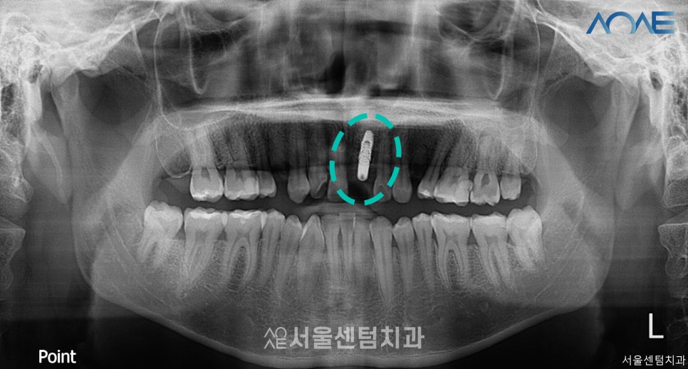 당일임플란트 상담부터 풀과정 공개 관련 이미지 6