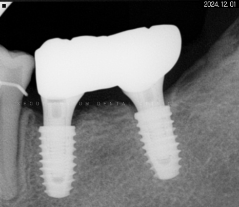 돌출입 및 신경치료와 임플란트 식립 동시 진행 증례 관련 이미지 24