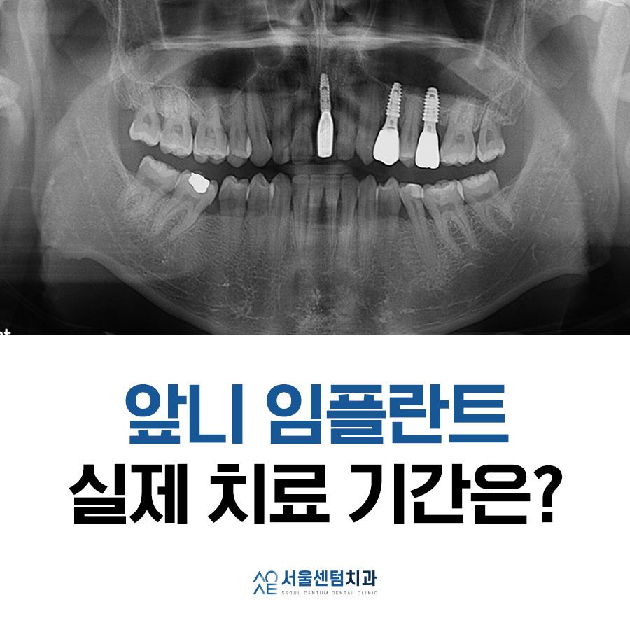 앞니 임플란트기간 실제 수술사례로 알려드려요 관련 이미지 7