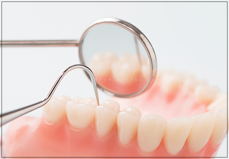 임플란트 뼈이식이 필요한 경우 구체적으로 확인하고 싶다면 관련 이미지 2