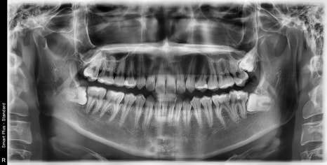 신사역 매복 사랑니 4개 발치 꼭 해야하나요? 관련 이미지 5
