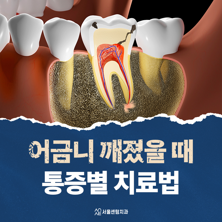 어금니 깨졌을 때 통증별 치료법 관련 이미지 1
